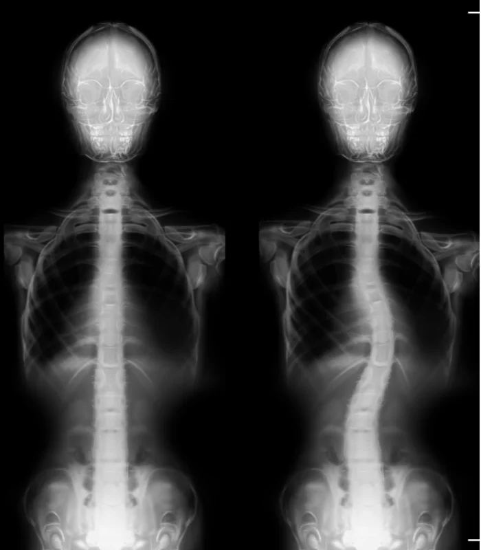 Scoliosis Treatment In Pellston